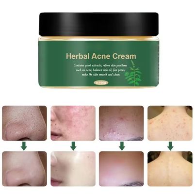 Biologische kruidengeneesmiddelen Acne Remover acnebehandeling reparatie littekencrème