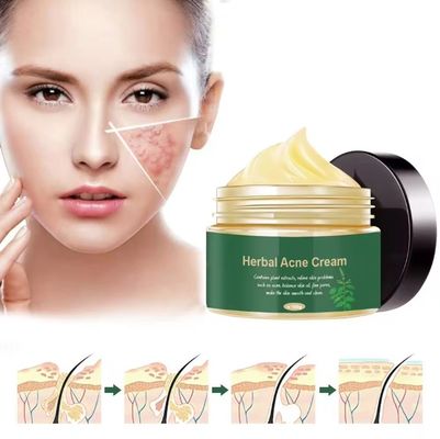 Biologische kruidengeneesmiddelen Acne Remover acnebehandeling reparatie littekencrème