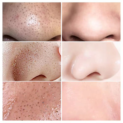 Eliminatore di punti neri siero naturale organico anti-invecchiamento riparazione del viso siero cura della pelle