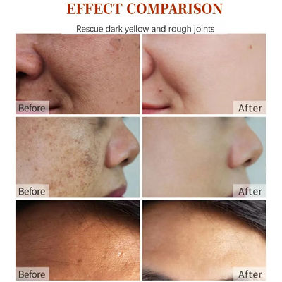 Gezicht Zwarte sproeten Acne Vervagen Donkere vlekken Verwijder corrector Bleekcrème